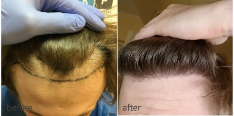Hair transplant results - Klinika Przybylski