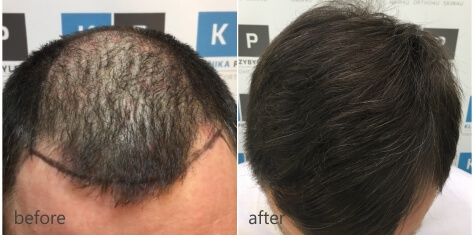 Przeszczep włosów efekty – Klinika Przybylski