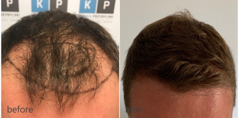 Przeszczep włosów efekty – Klinika Przybylski