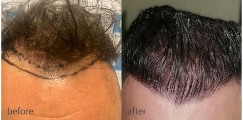 Przeszczep włosów przed i po