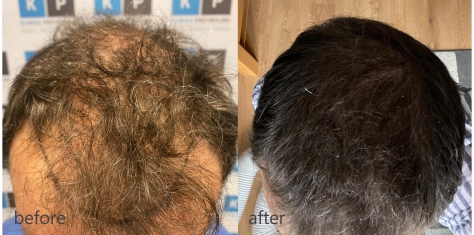 Transplantacja włosów przed i po