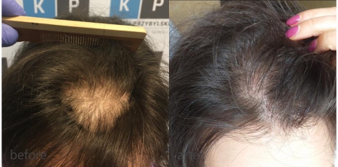 Przeszczep włosów u kobiet efekty – Klinika Przybylski