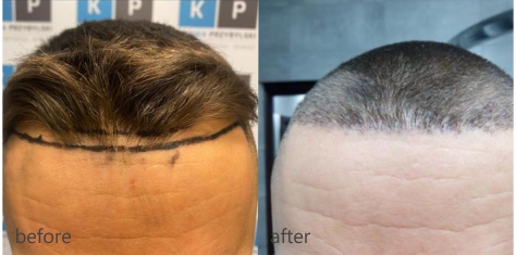 Przeszczep włosów u mężczyzn – Klinika Przybylski